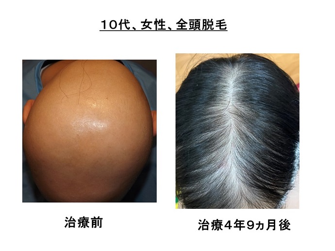 円形脱毛症　病院